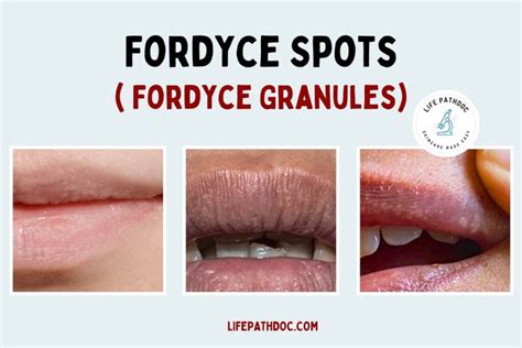 grain de fordyce|Fordyce spots